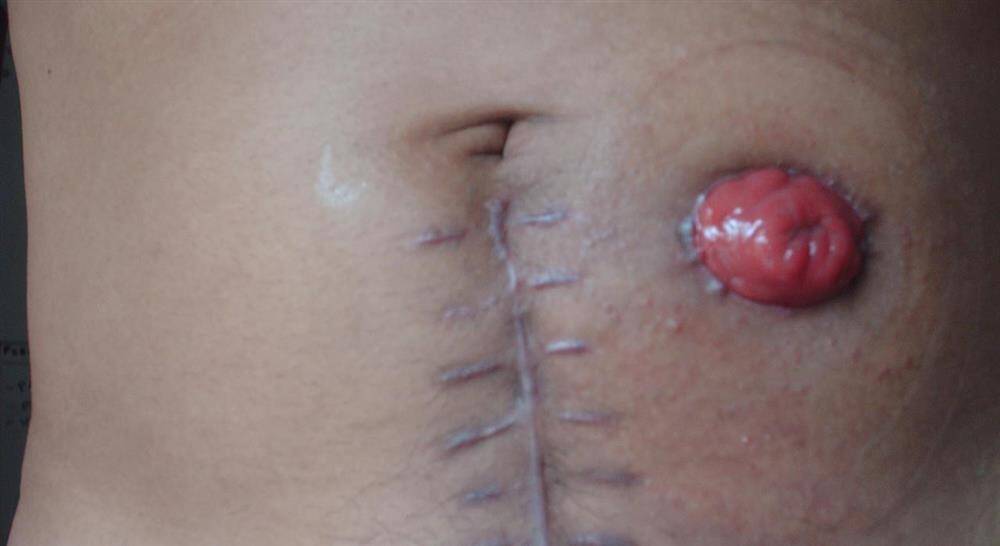 formacion técnicas de enfermería digestiva y ostomías