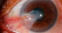 diplomado online cirugía oftalmológica para enfermería