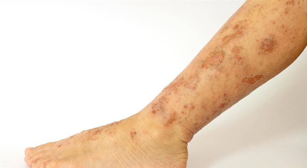 diplomado enfermería en hematología dermatología y farmacología en urgencias en atención primaria