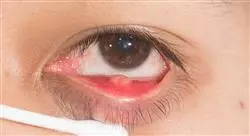 curso infecciones oftalmológicas otorrinolaringológicas y de la cavidad oral en urgencias para enfermería
