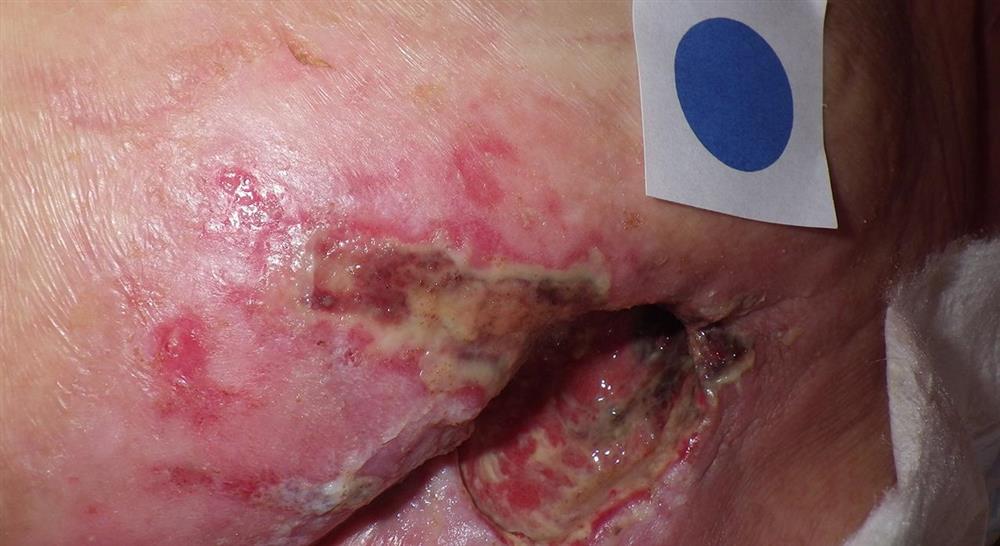diplomado infecciones osteoarticulares piel y partes blandas en urgencias para enfermería