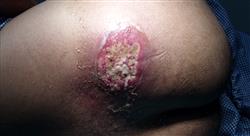 estudiar infecciones osteoarticulares piel partes blandas 6