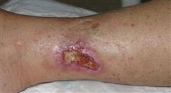 posgrado infecciones osteoarticulares piel y partes blandas en urgencias para enfermería
