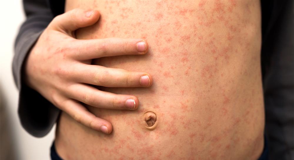 Diplomado en Enfermedades Infecciosas en Urgencias del Paciente Pediátrico para Enfermería