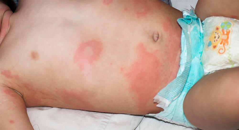 Diplomado en Enfermedades Infecciosas en Urgencias del Paciente Pediátrico para Enfermería