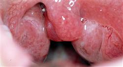 curso enfermedades infecciosas en urgencias del paciente pediátrico para enfermería