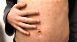 curso enfermedades infecciosas urgencias paciente pediatrico enfermeria 1