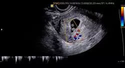 diplomado online actualizaciones en patología placentaria y de los anejos fetales y sus principales urgencias obstétricas para enfermería