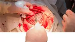 corsi semipresenziali master semipresenziale neurochirurgia Tech Universidad