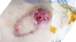 curso presencial enfermedades infecciosas servicio urgencias Tech Universidad
