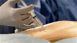 diplomado cuidados criticos anestesia regional TECH Universidad