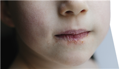 ensino a distancia dermatologia pediatrica Tech Universidad