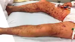 estagio doencas infecciosas depart urgencias enfermagem Tech Universidad