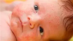 experto infeccion periodo neonatal TECH Global University