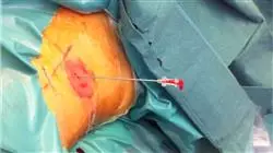 magister actualizacion cirugia urologica Tech Universidad
