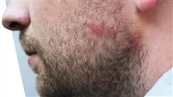 master actualizacion dermatologia clinica Tech Universidad