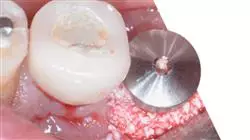 master degree dental prosthesis TECH Global University
