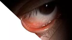 master oftalmogia clinica Tech Universidad