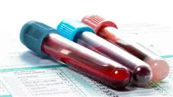 master tirocinio avances ematologia emoterapia TECH Global University