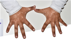 master tirocinio dermatologia pediatrica Tech Universidad
