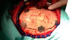 master tirocinio master semipresenziale neurochirurgia Tech Universidad