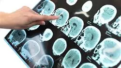 master tirocinio medicina riabilitativa approccio danno cerebrale acquisito TECH Global University