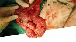 master tirocinio progressi gastroenterologia epatologia pediatrica Tech Universidad