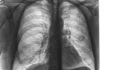 mestrado enfermagem servico pneumologia Tech Universidad