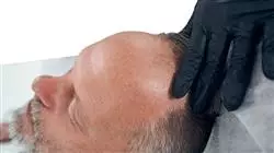 praktikumsprogramm haartransplantation Tech Universidad