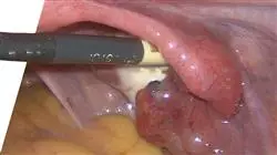 prasenzstudium endometriose Tech Universidad