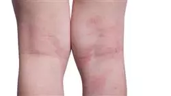 prasenzstudium padiatrische dermatologie Tech Universidad