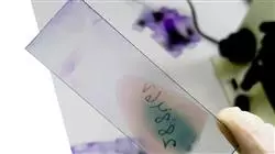 semipresencial medicina genomica precision hematologia trombosis Tech Universidad