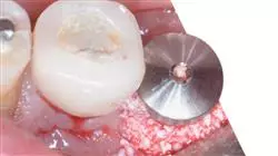 semipresencial protesis dental Tech Universidad