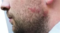 stage universitari aggiornamento dermatologia clinica Tech Universidad