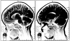 study speech neurorehabilitation vital function analysis orofacial myofunctional therapy Tech Universidad